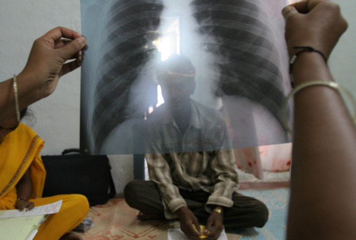 tuberculosis